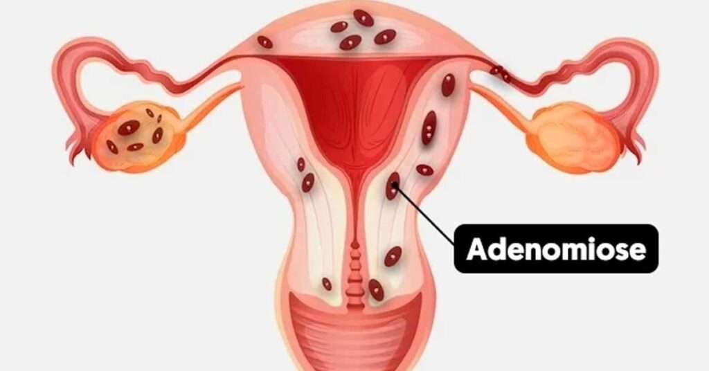 Adenomiose